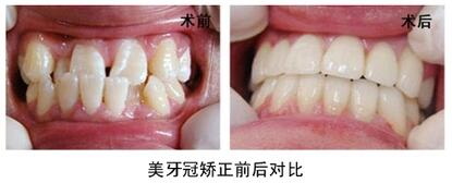 14周岁矫正牙齿晚吗?