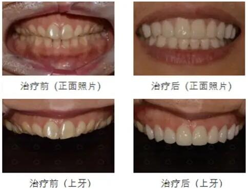 烤瓷牙为什么会失败,它有哪些拯救方案