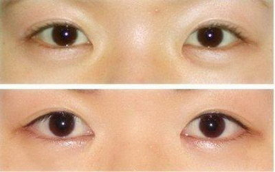 眼睑下垂怎么自己纠正[先天性眼睑下垂怎么自己纠正]