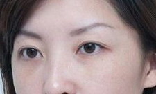 激光做黑眼圈有没有效果(激光去黑眼圈有没有效果)