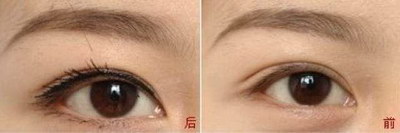 割双眼皮大小眼怎么办(做了双眼皮后大小眼怎么办)