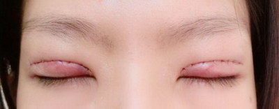 平行双眼皮可以变成扇形双眼皮吗(什么是平行双眼皮和扇形双眼皮？)