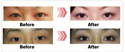 如何去除黑眼圈最快男(如何去除黑眼圈最快方法)