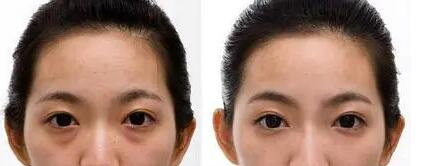 双眼皮哪里做的好济南(济南哪里做双眼皮好？)