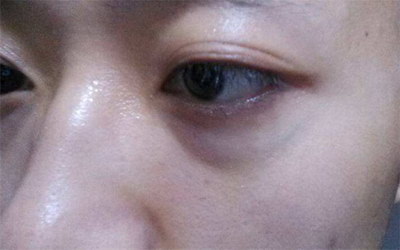 割完双眼皮闭眼凹陷