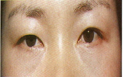 双眼皮术后眼皮淤血怎么办