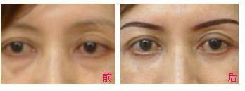疤痕红印怎么治疗好(双眼皮疤痕粘连怎么治疗)