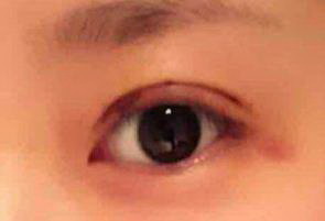 深圳不开刀去眼袋
