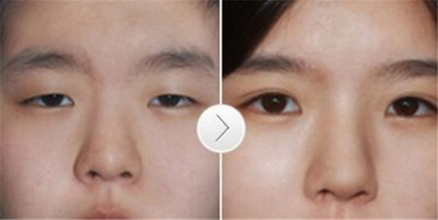 眼角赘皮是什么意思_眼角小细纹怎么去