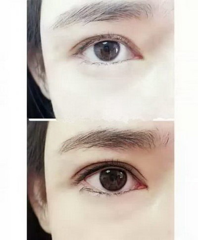 双眼皮没有拆线(做了双眼皮没有拆线能带美瞳吗)