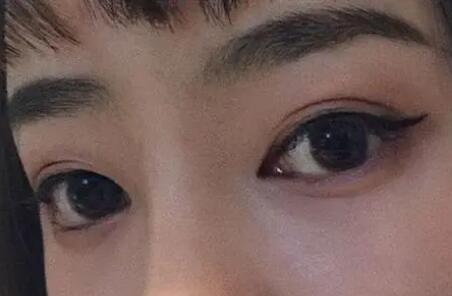 做双眼皮手术是冷敷还是热敷(冷敷还是热敷？——双眼皮手术恢复)