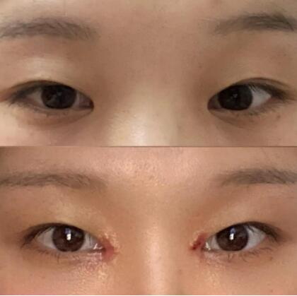 埋线双眼皮需要多少钱啊你可清楚？