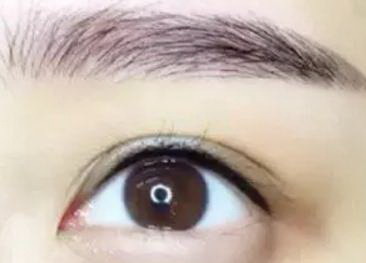 微创双眼皮术后多久能恢复?