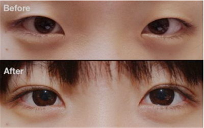 去眼袋的有效成分有哪些?