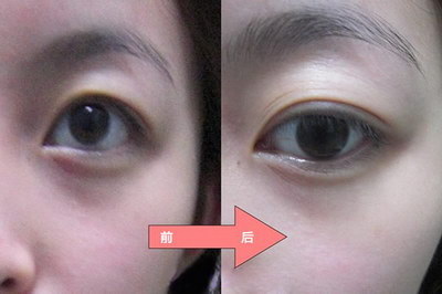 双眼皮切口上方很厚的原因(双眼皮切口上方有折痕怎么办)
