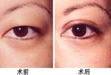 眼泡特别肿有什么办法可以去除(怎样去除特别肿的眼袋)