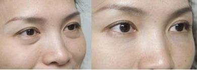 开眼角手术后眼睛闭不上