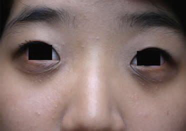 眼睛水肿什么原因怎么消除(脸眼睛水肿是什么原因)