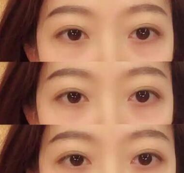做完双眼皮手术眼睛看不清正常吗(双眼皮手术后眼睛看不清怎么回事)