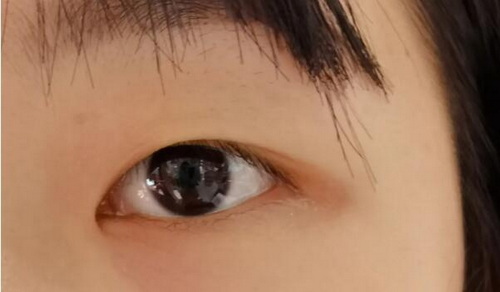 做双眼皮手术后的护理有什么要求呢？