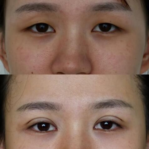 冻干粉可以修复术后双眼皮吗(做完双眼皮可以用冻干粉修复吗)