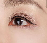 眼皮松弛成多层眼皮怎么办