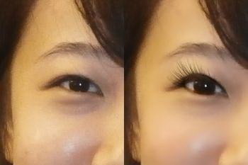 双眼皮失败修复最佳时间(双眼皮失败修复最佳时间)