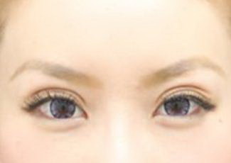 自体脂肪填充眼窝多久可以化妆