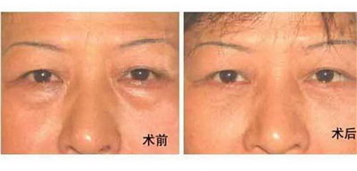 一只眼睛内双一只眼睛外双怎么办