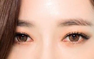 天生上眼睑下垂怎么造成的(天生上眼睑下垂怎么办)