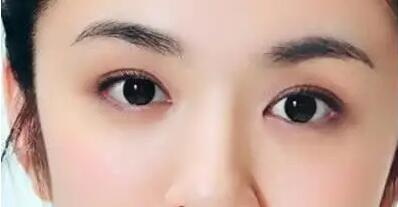 开外眼角手术的手术效果如何呢？