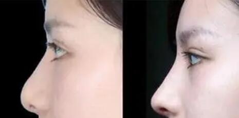 一个眼睛双眼皮一个单眼皮咋回事(双眼皮和单眼皮的区别)