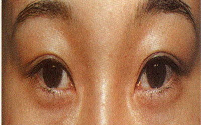 开内眼角疤痕增生的照片