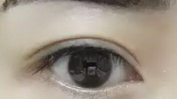 眼皮一个单,一个双怎么办(如何解决一只眼皮单、一只眼皮双的问题？)