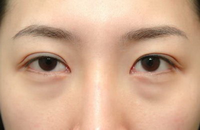 感冒眼部浮肿怎么消除_怎样清除眼部鱼尾纹