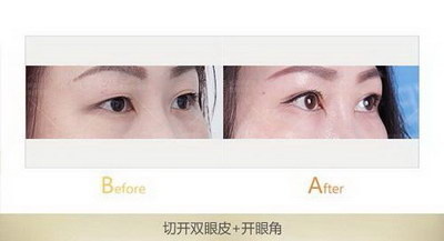 圆脸适合什么双眼皮好看(圆脸适合做什么样的双眼皮)