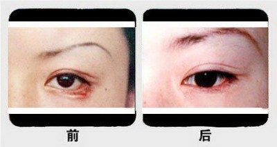 埋线双眼皮20天能敷吗