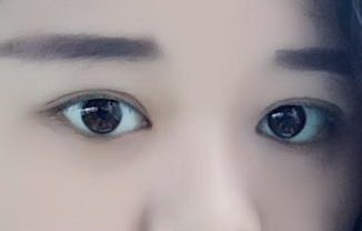 先天性眼睑下垂有什么危害(先天性眼睑下垂有什么危害)