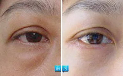 怎么除男人眼袋_打除皱针眼袋