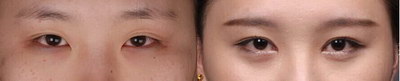 做眼袋有什么危害(眼袋，别小觑了它)