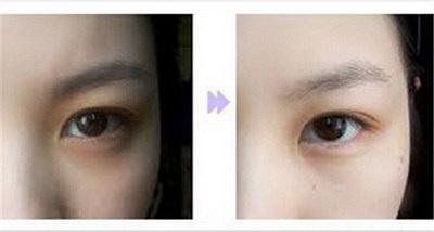 双眼皮贴可以矫正眼睛大小吗(双眼皮贴可以矫正眼皮吗)