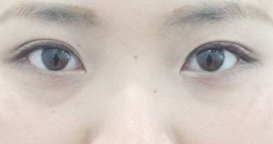怎样让眼皮变成双眼皮