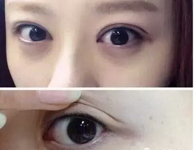 全切双眼皮增生是什么样子(什么是全切双眼皮增生？)