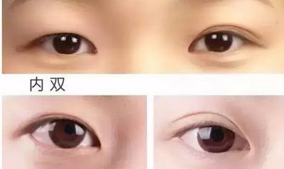 眼皮吸脂的危害