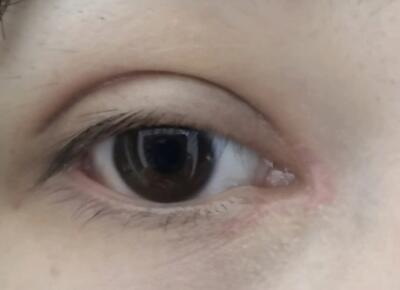 双眼皮术后注意事项有哪些?