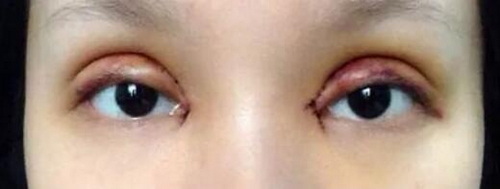 影响开眼角手术价格的因素是什么