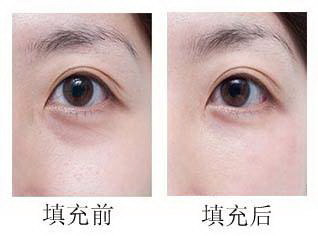 开外眼角手术一般多长时间_开外眼角手术需要多长时间