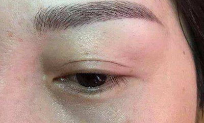 埋线失败后要马上拆线吗？