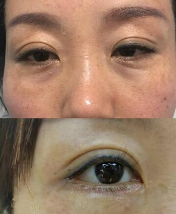 两个眼睛眼皮不一样的女生性格(埋线双眼皮两个眼睛不一样)