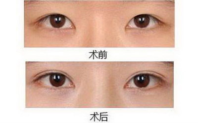眼袋泪沟怎么治疗效果最好[有眼袋泪沟松弛怎么治疗]
